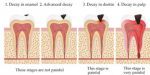 cavity 2