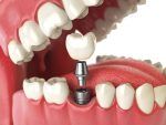 implant_shutterstock_447016423