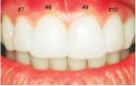 veneersAfter