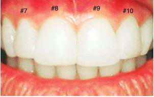 Veneers After