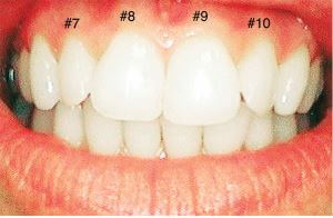 Veneers Before