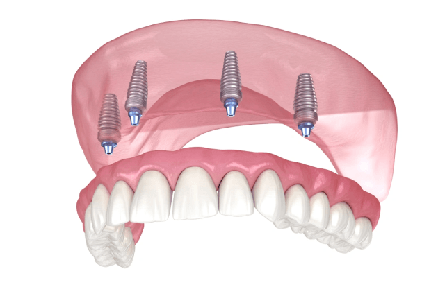 full arch dental implants