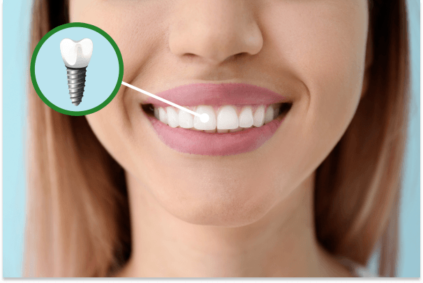 single tooth implant tooth